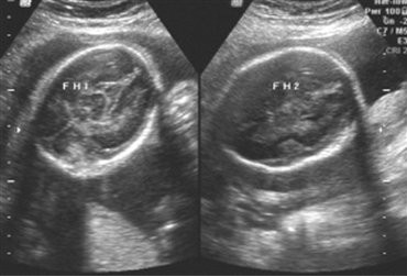 怀孕7个月胎儿b超图介绍