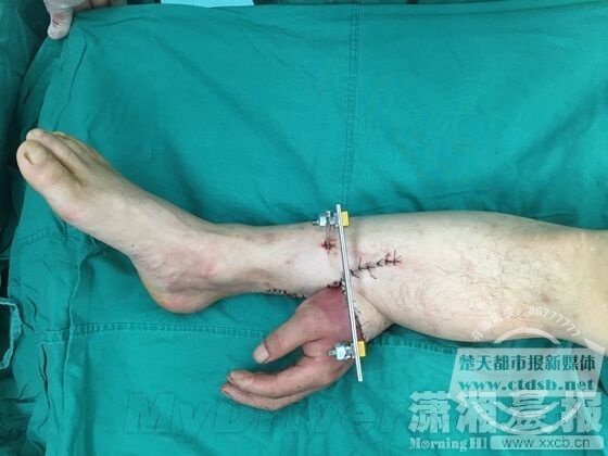 画面残暴:断手寄养在小腿上 后成功回植