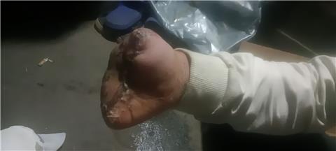 17岁小伙在即墨区一家工厂工伤，起诉至法院立案至今八个月无任何进展